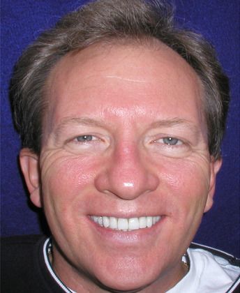 After full mouth reconstruction